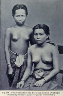 114. Zwei Siamesinnen mit Rock und nacktem Oberkörper 