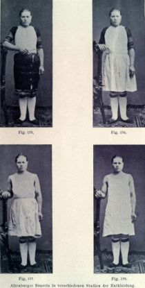 175. bis 178 Altenburger Bäuerin in verschiedenen Stadien der Entkleidung
